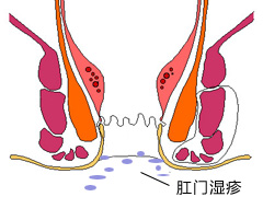 肛门湿疹是怎么回事